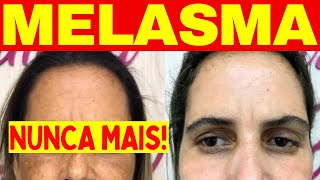 MELASMA  Como Acabar Com MELASMA NO ROSTO Caseiro FÓRMULA AMERICANA [upl. by Lief]