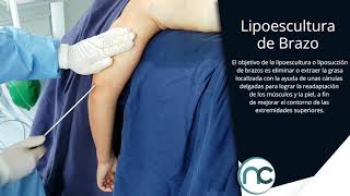 Dr Nelson Chaves  Lipoescultura de Brazo [upl. by Ivets]