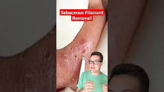 Major BLACKHEAD REMOVAL  Popping Sebaceous Filaments shorts [upl. by Barri16]