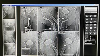 Ascending Cystourethrography اشعه صاعده علي قناه مجري البول [upl. by Iahc394]