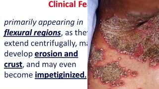 10 MIN REVISION impetigo Herpetiformis [upl. by Cannice548]