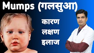 Mumps Symptoms Treatment  Galsua ka ilaj  Mumps [upl. by Carny]