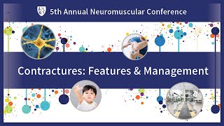 Contracture development amp management in Duchenne muscular dystrophy  Spinal Muscular Atrophy 2023 [upl. by Nylidam79]