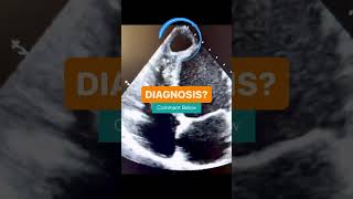 Diagnosis echocardiography hydatidcyst [upl. by Gorden537]