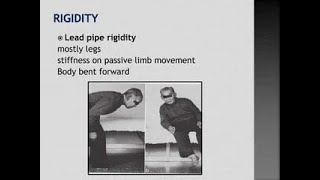 Meaning of Lead Pipe Rigidity Seen in Parkinsons Disease [upl. by Ursi428]