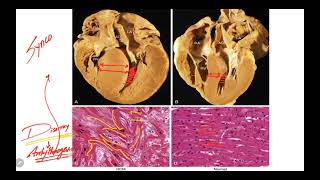 IM Cardiology 15 Cardiomyopathies Hypertrophic cardiomyopathy HCM [upl. by Ravaj421]