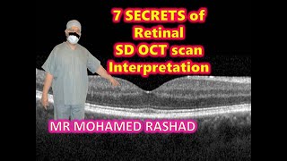 Super secrets to easily interpret Retinal Spectral Domain Optical Coherence Tomography [upl. by Rahsab]