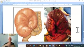 Intestinal disorders in Arabic 9  Volvulus  part 1   by Dr Wahdan [upl. by Adnohsal]