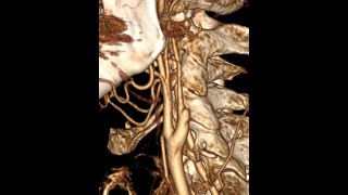 Case of internal carotid artery dissection MRI CTA and Duplex Scanning images and videos [upl. by Jeanne]