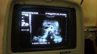 ASCITES ultrasound [upl. by Rape783]