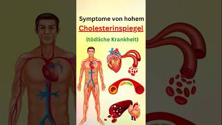 Symptome von hohem cholesterinspiegel [upl. by Atnohs]