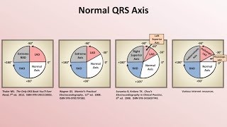 Intro to EKG Interpretation  Rate and Axis [upl. by Aivatnahs]