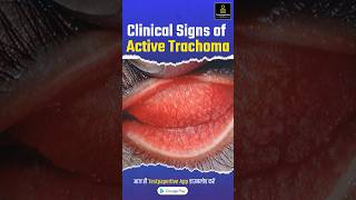 Clinical signs of active trachoma trachoma Clinicalsigns eye ophthalmology testpaperlive [upl. by Sacttler]