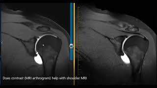 Does MRI arthrogram help see the labrum [upl. by Audette]