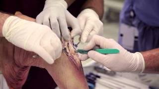 Patellar Tendon Graft [upl. by Auqenet]