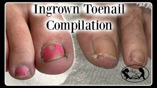 Ingrown Toenail Pedicure [upl. by Anirbes]