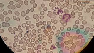 Blood film smear shows normochromic normocytic crenated red cells and aggregation of platelets [upl. by Naawaj]