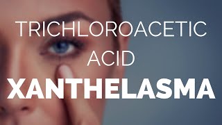 Trichloroacetic acid xanthelasma does it work [upl. by Eisac205]