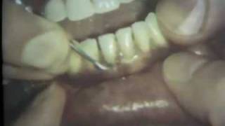 Dental Scaling and Root Planing  Treatment of Gum Disease [upl. by Aicercul]