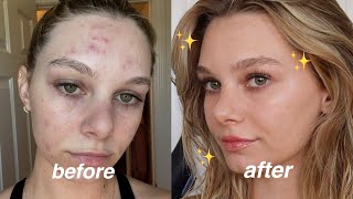 Everyday Natural Makeup Routine with Acne  how i cover my acne [upl. by Okomom]