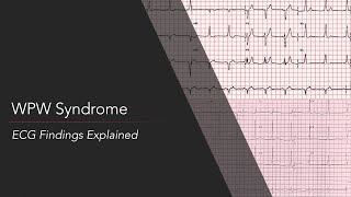 WolffParkinsonWhite WPW Syndrome ECG [upl. by Tarkany]