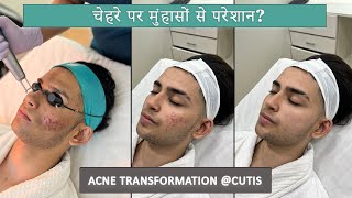 Acne Transformation Journey of deepakjoshii  From Insecurities to Confidence [upl. by Cinom]