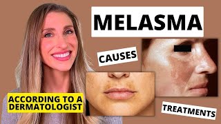 Best Melasma Treatment Dermatologist Explains Melasma Causes At Home Treatments amp More [upl. by Llennaj]