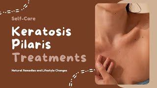 Spavelous Talks Keratosis Pilaris Treatments SelfCare for Chicken Skin [upl. by Timi806]