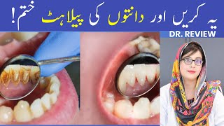 The 1 Top Remedy for Dental Plaque TARTAR [upl. by Uriia]