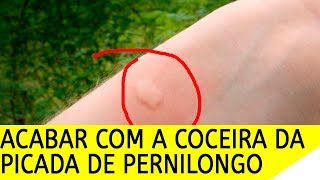 COMO ACABAR COM A COCEIRA DA PICADA DE PERNILONGO E INSETOS [upl. by Sadirah]