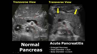 Pancreas Ultrasound Normal Vs Abnormal Image Appearances Comparison  Pancreatic Pathologies USG [upl. by Arretnahs]