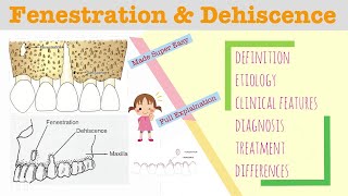 Fenestration and Dehiscence I Periodontology Lectures [upl. by Joice]