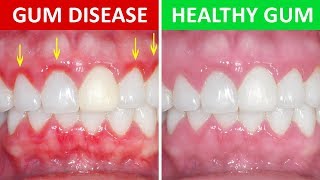 How to Get Rid of Gingivitis at Home Gum Disease [upl. by Koppel]