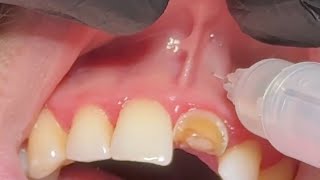 Local Anesthesia For Extraction Upper Central incisor  anterior superior and nasopalatine nerve [upl. by Ebner]