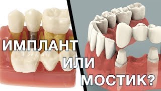 Имплант или зубной мостик Что лучше выбрать Имплантация зубов Мост зубной [upl. by Ecnerwaled]