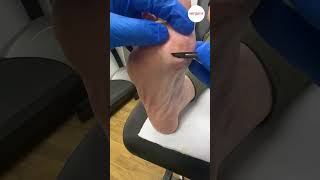 Hard skin removal from ball of foot [upl. by Leksehcey996]