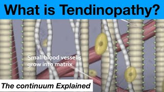 The Tendinopathy Tendon Tendonitis Continuum Theory Explained [upl. by Morten]