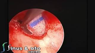 Keratosis Obturans Endoscopic Surgery [upl. by Toombs]