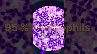 pleural pleuraleffusion blood cbc fluid giemsastain [upl. by Ayr]