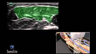 How To Ultrasound Guided Median and Ulnar Nerve Block 3D Video [upl. by Sillsby]