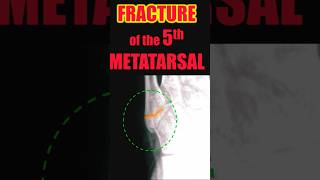 Fracture of the 5th Metatarsal trauma radiology doctor [upl. by Baptista]