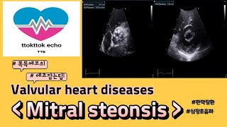 Mitral stenosis MS 승모판 협착증 심장판막 이첨판 판막질환echocardiography 심장초음파 heart echo view [upl. by Llerat]