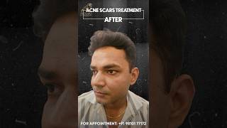 acnescars acnetreatment dermapen youtubeshorts gurugram youtubeshorts viralshorts [upl. by Mozza]