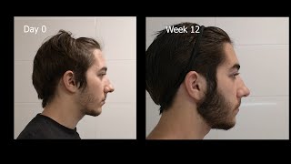 Minoxidil Beard Growth  3 Month Transformation  Timelapse BEFORE and AFTER [upl. by Aneri428]