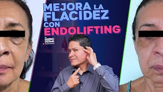 MEJORA LA FLACIDEZ FACIAL CON ENDOLIFTING  Consejos de un Dermatólogo [upl. by Onairam736]