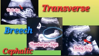 Transverse Breech amp Cephalic Baby In Uterus Genderreveal  Anterior Posterior Placenta Baby Gender [upl. by Yhprum]