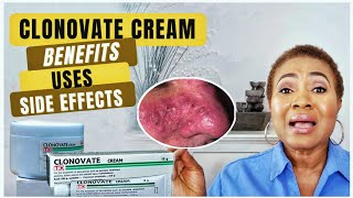 WHY CLONOVATE CREAM SHOULDNT BE USED FOR SKIN WHITENINGBENEFITSSIDE EFFECTS [upl. by Fosque]