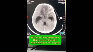 Posterior fossa SOL Brain tumor CT scan High pressure obstructive non communicating hydrocephalus [upl. by Delora458]