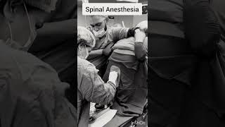 Spinal Anesthesia Procedure [upl. by Zacks]