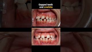 Braces for gapped teeth and overbite braces orthodontist bracesoff dentist [upl. by Bohs63]